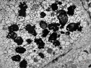 M,17y. | lipofuscin - hyperbilirubinaemia - Gilbert or Dubin-Johnson syndrome M,17y. | lipofuscin - hyperbilirubinaemia - Gilbert or Dubin-Johnson syndrome